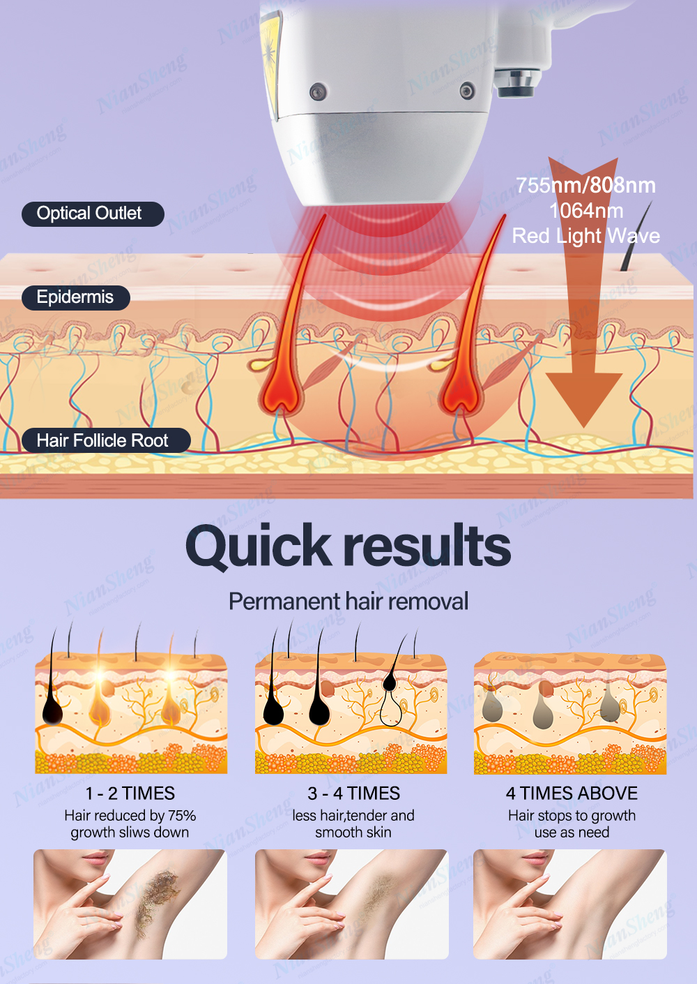 laser hair removal